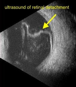 Retinal Repair Radiopaedia Retinal Detachment Ultrasound Radiopaedia