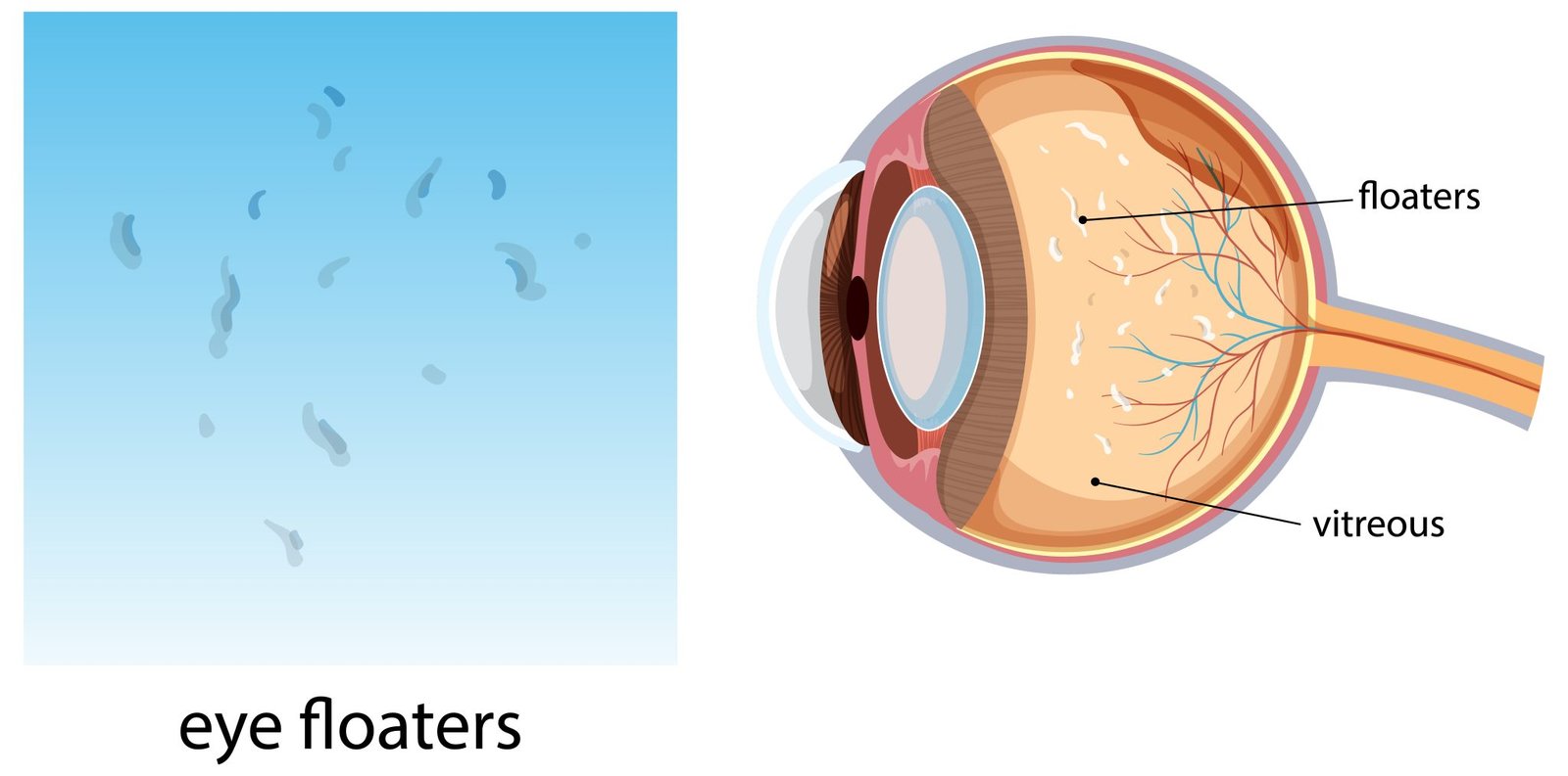 Retinal Flash Flashing Lights & Floaters: When to See a Retina Specialist
