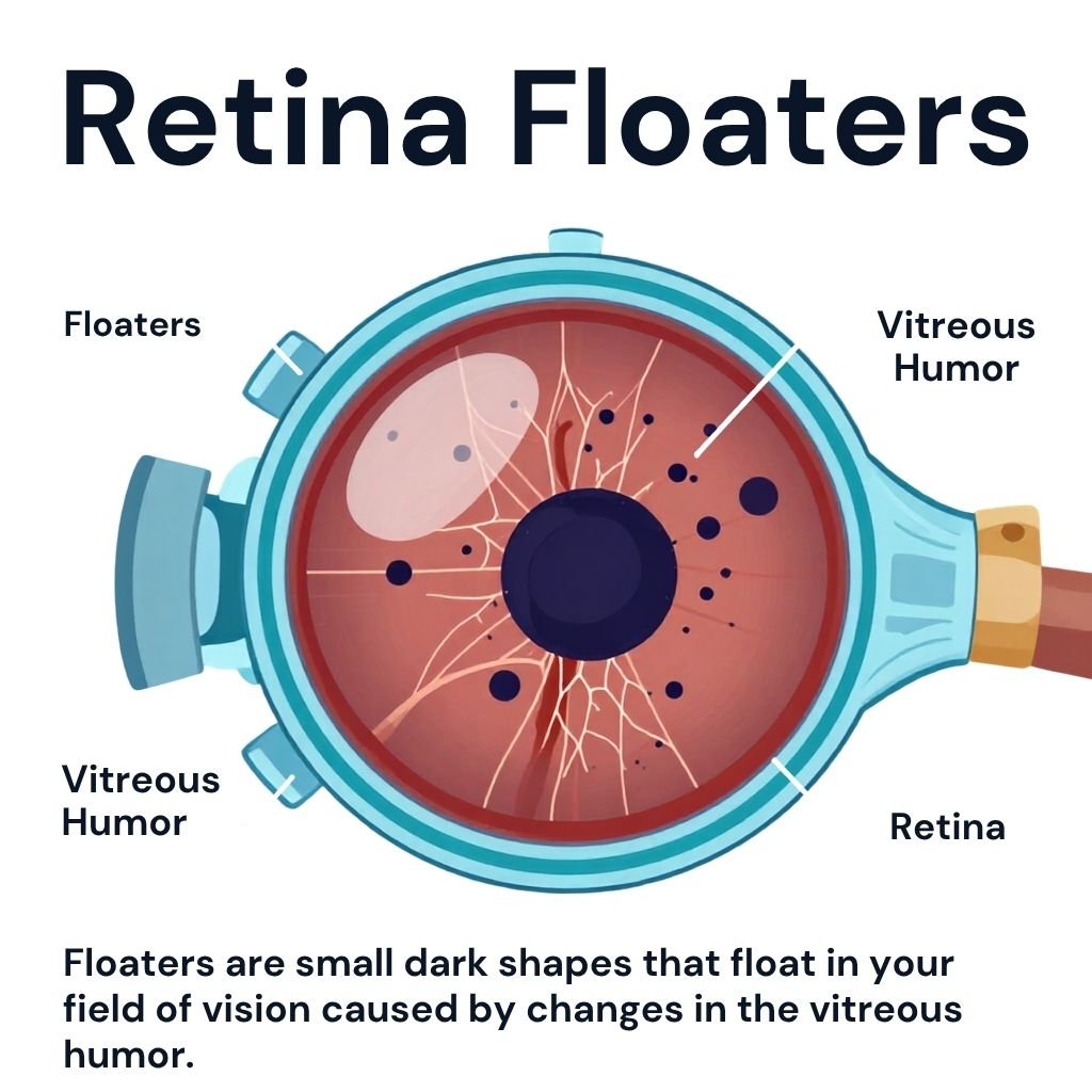 Guilda Floaters Floaters Treatment in Sherman, TX | Retina Specialists
